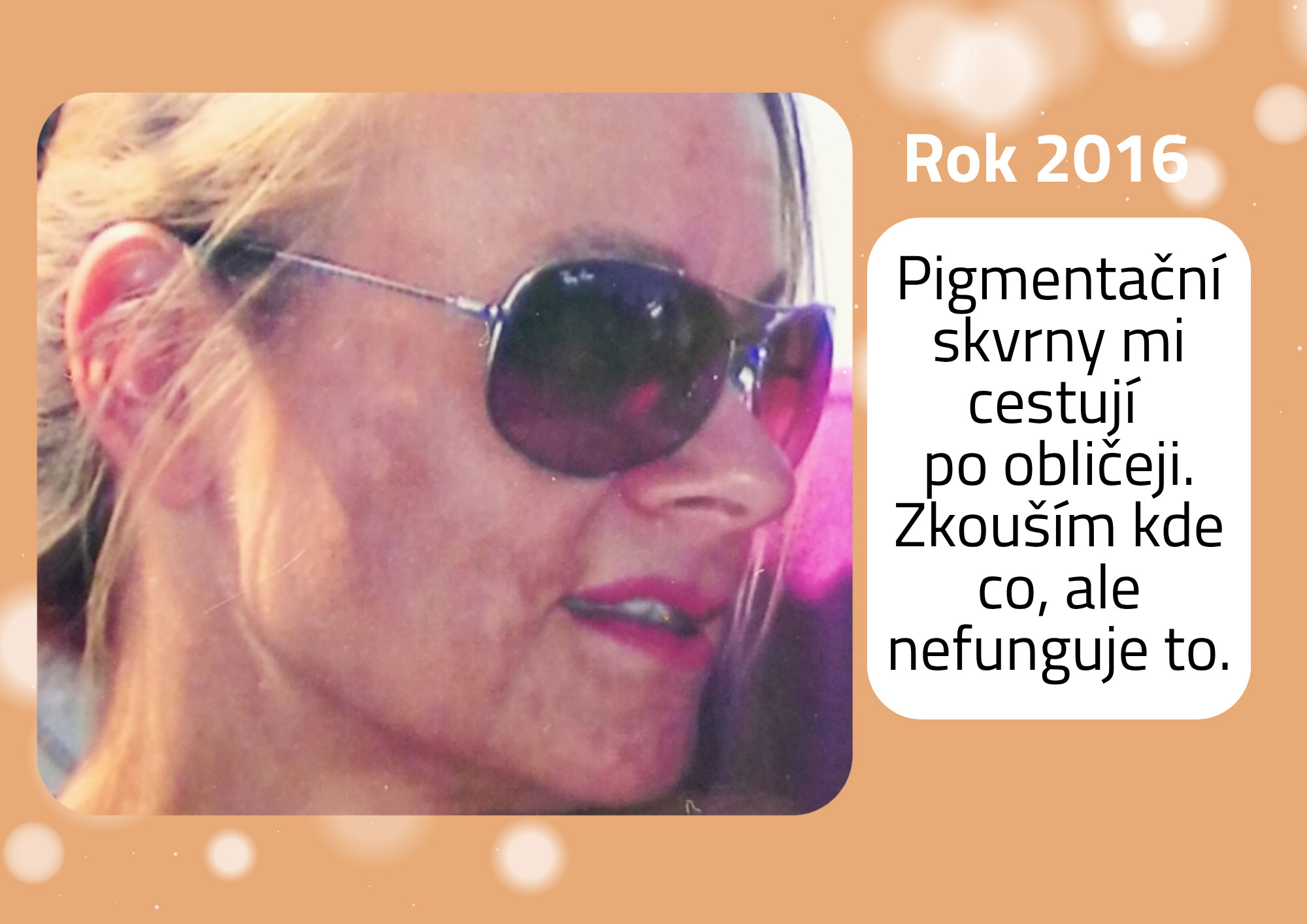 pigmentační skvrny