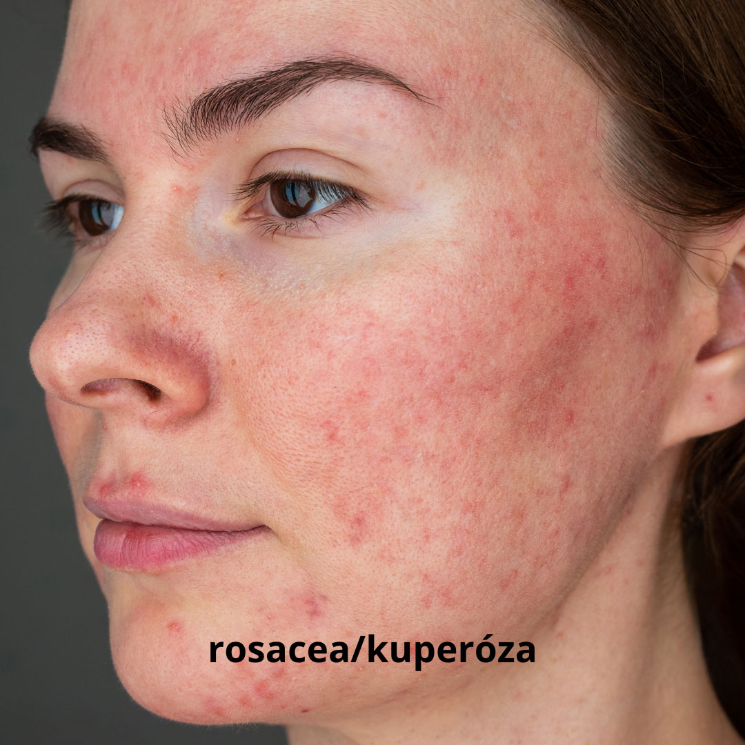 foto - pleť s rozšířenými žilkami, kuperóza, rosacea