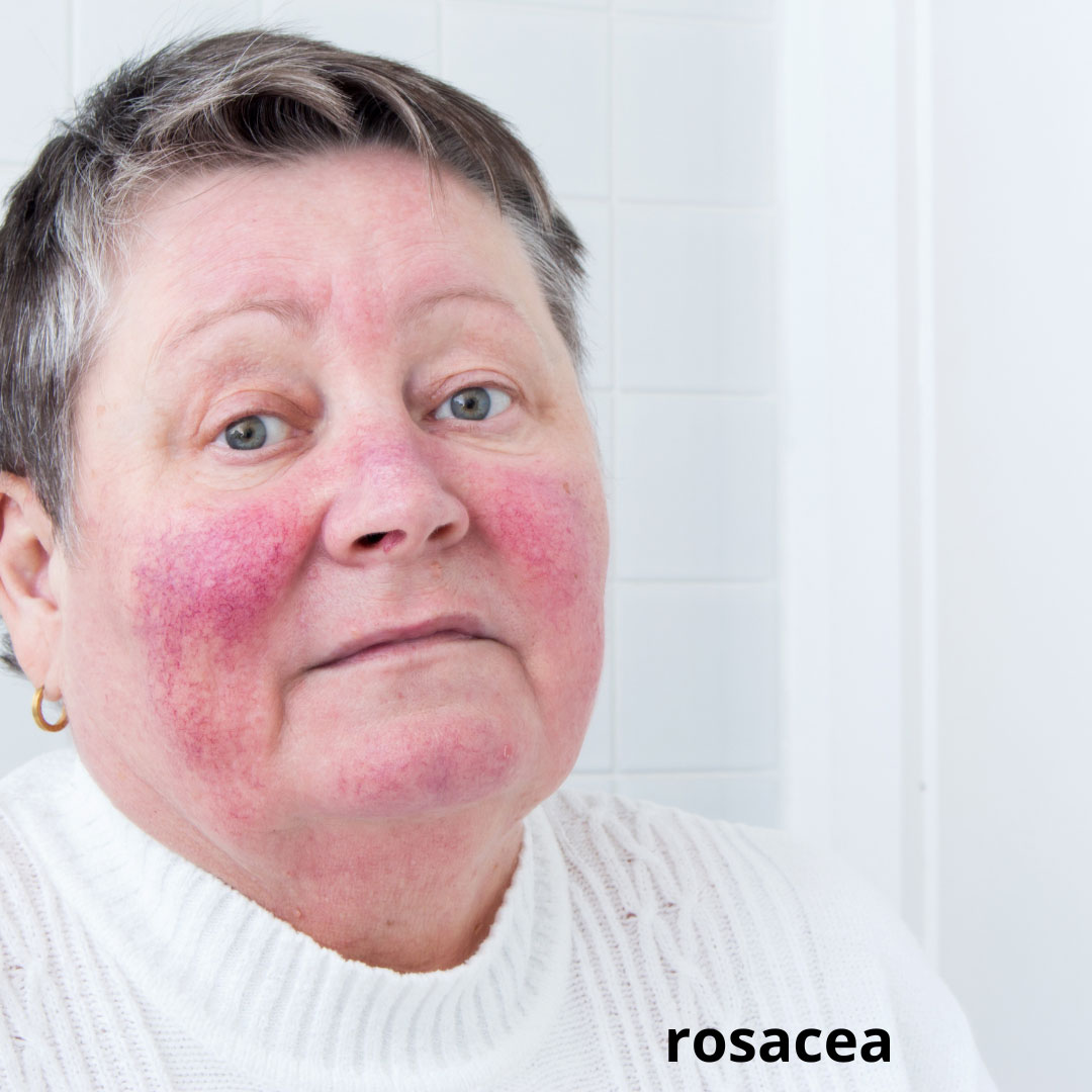 foto - pleť s rozšířenými žilkami, rosacea