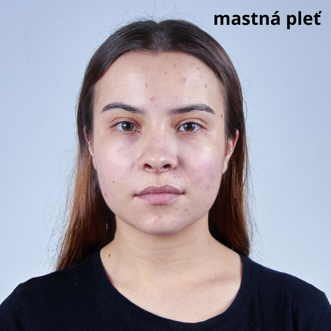 foto - mastná pleť